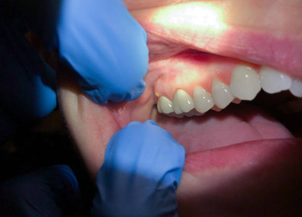 Best Emergency Dental Extractions in Breinigsville, PA