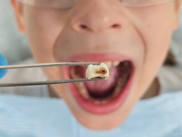 Best Emergency Dental Extractions in Breinigsville, PA